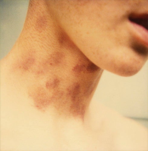 Mike Brodie, Hickeys on my neck, c. 2004-2006